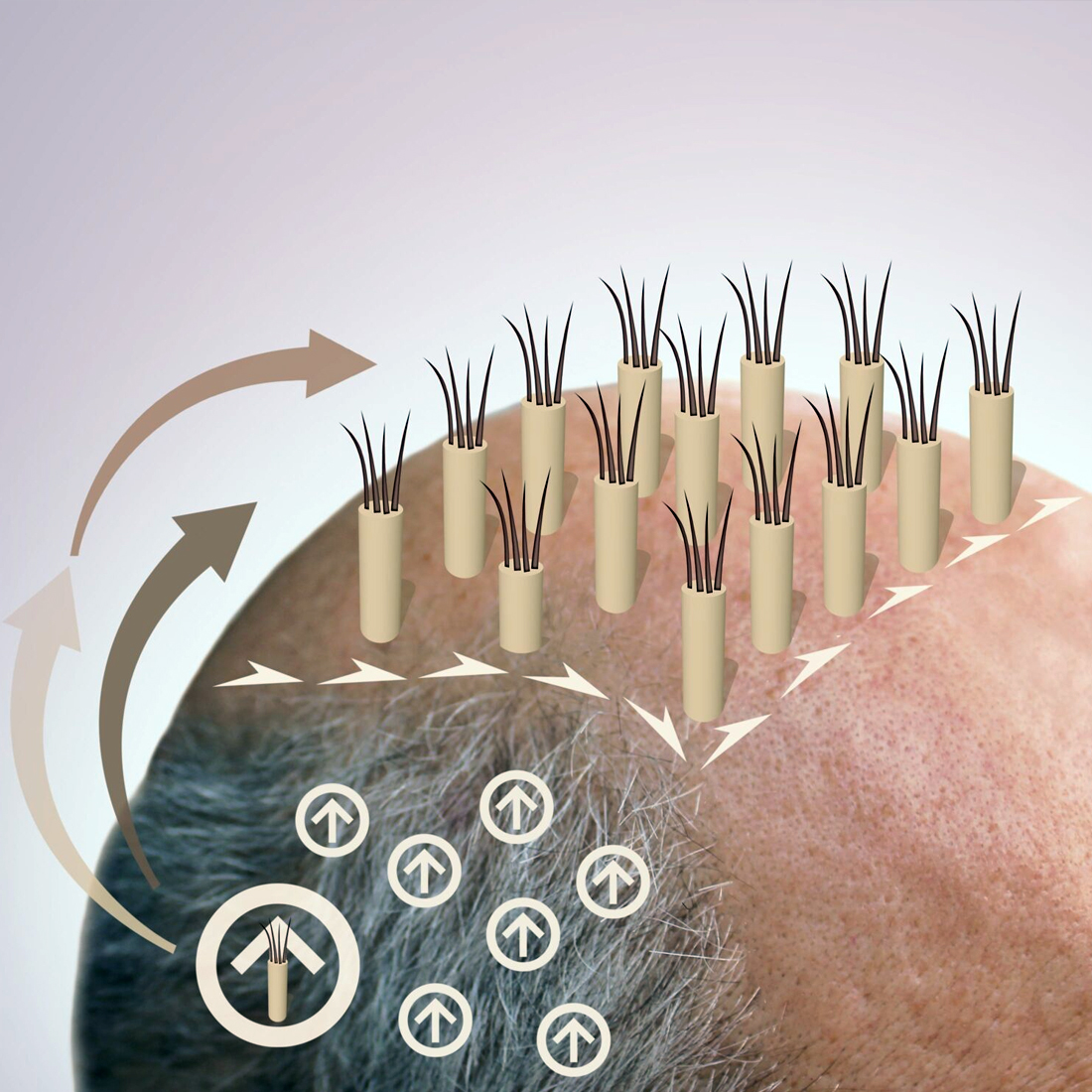 saç ekimi nişantaşı