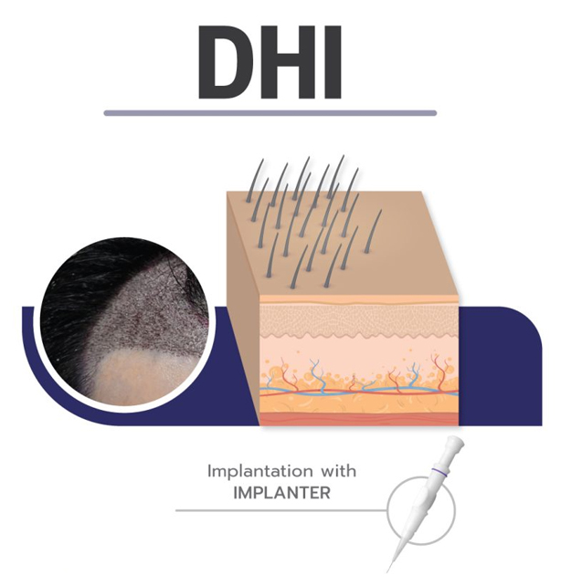 DHI Saç Ekimi