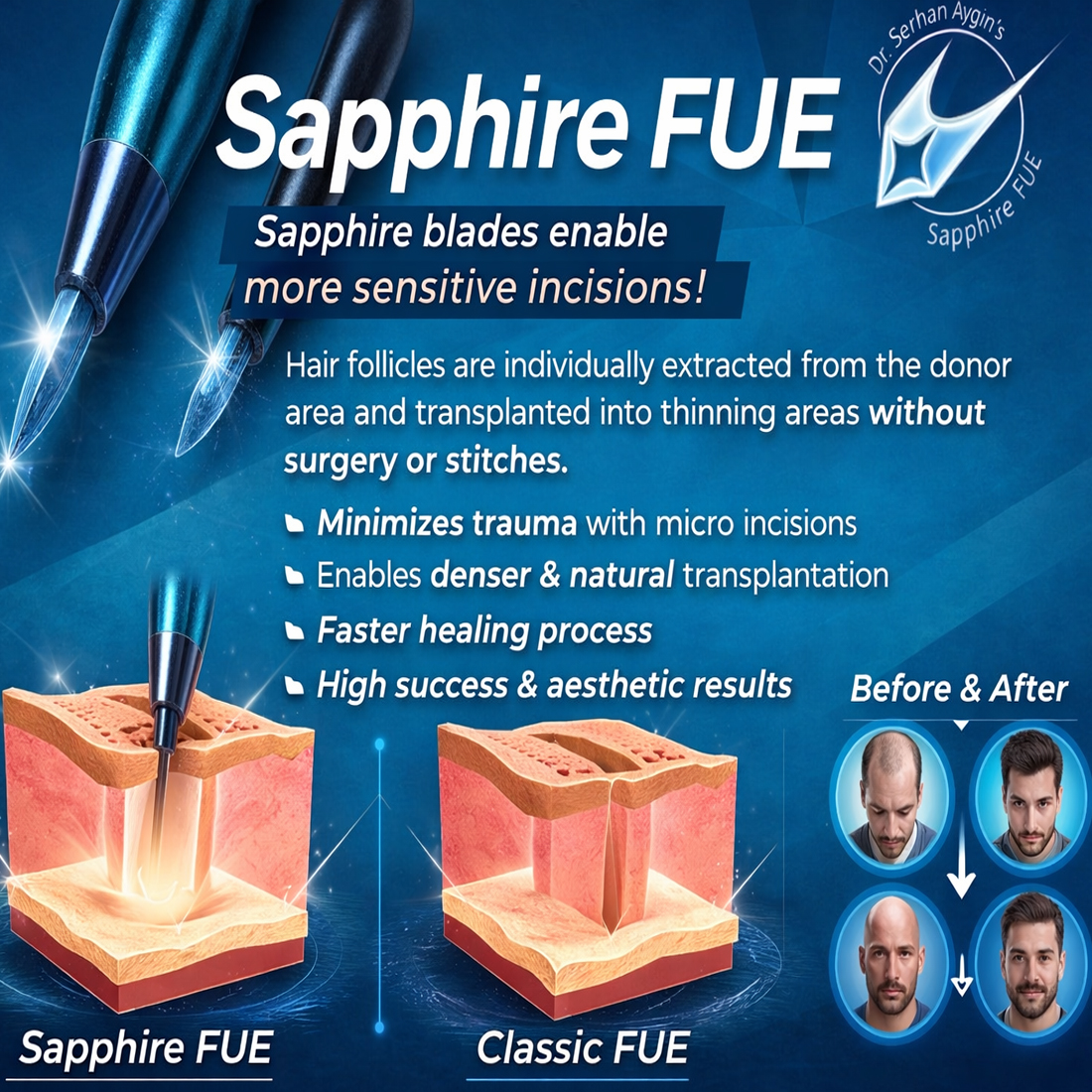 Sapphire FUE hair transplant istanbul